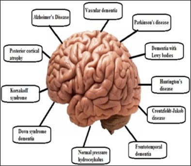 Dementia type of brain diseases