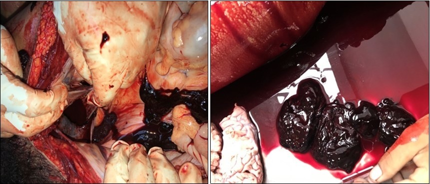  Blood and blood clots in the pelvic cavity