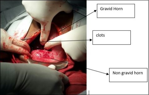  Intraoperative picture of the uterus with both horns and clots in peritoneal cavity