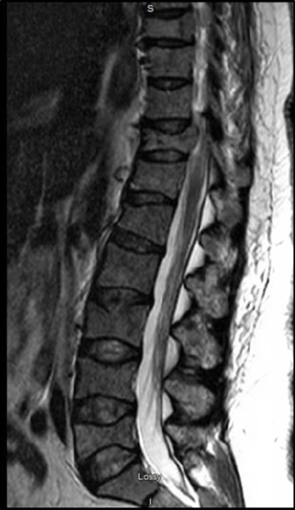  Several pathologic compression and burst fractures throughout the spine. Ventral cord indentation at T1, T8 and T11. Rostrocaudal cord edema spanning T10-T12 secondary to more significant cord compression. Bulky left paraspinal osseous/extraosseous disease at T8 (arrow) causing potential impingement. 