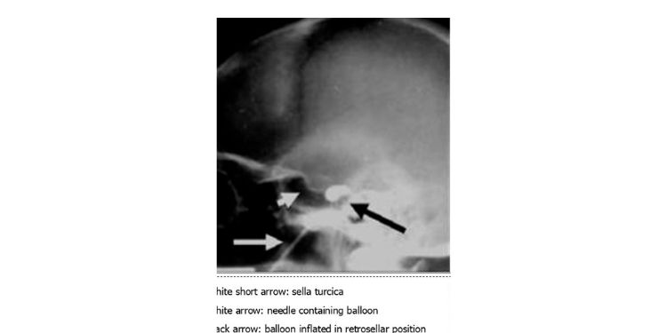 trigeminal neuralgia
